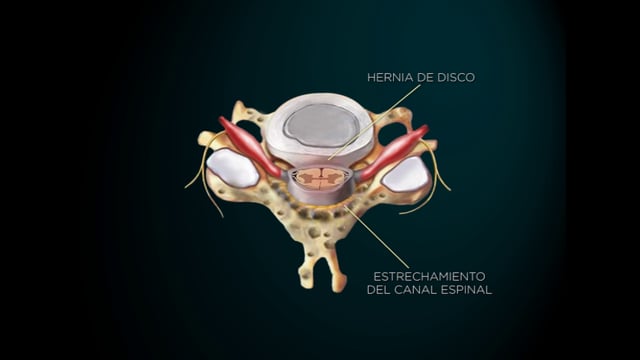 Estenosis Cervical
