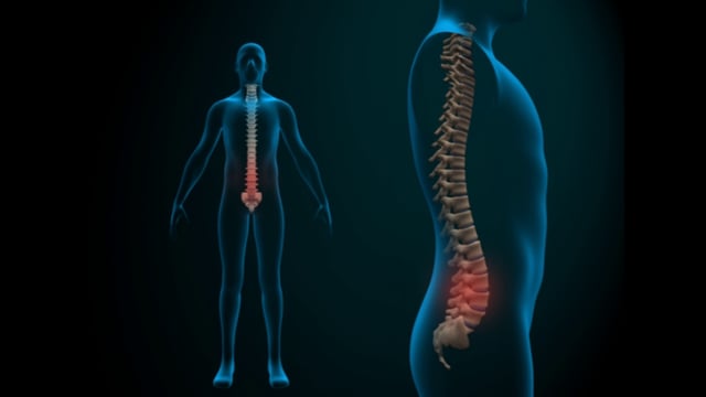 Estenosis Lumbar