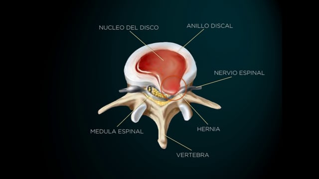 Hernia Discal Lumbar