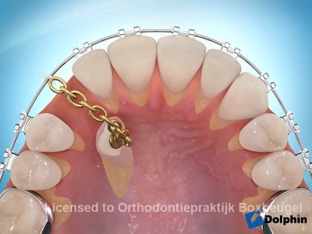 Hoektand vrijleggen