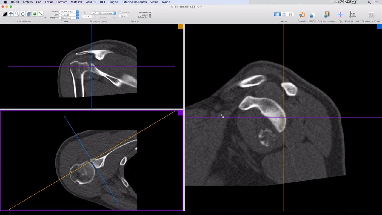 2.1 RECONSTRUCCIÓN MULTIPLANAR on Vimeo