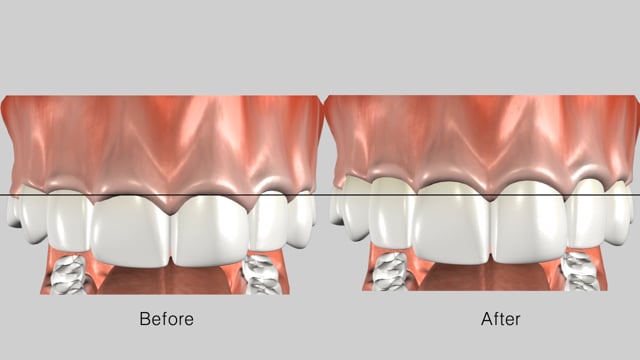 Crown Lengthening