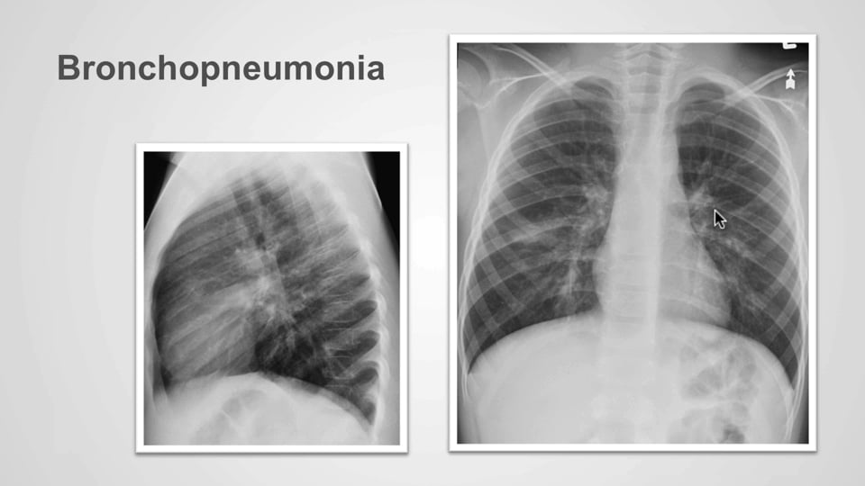 The many faces of pneumonia