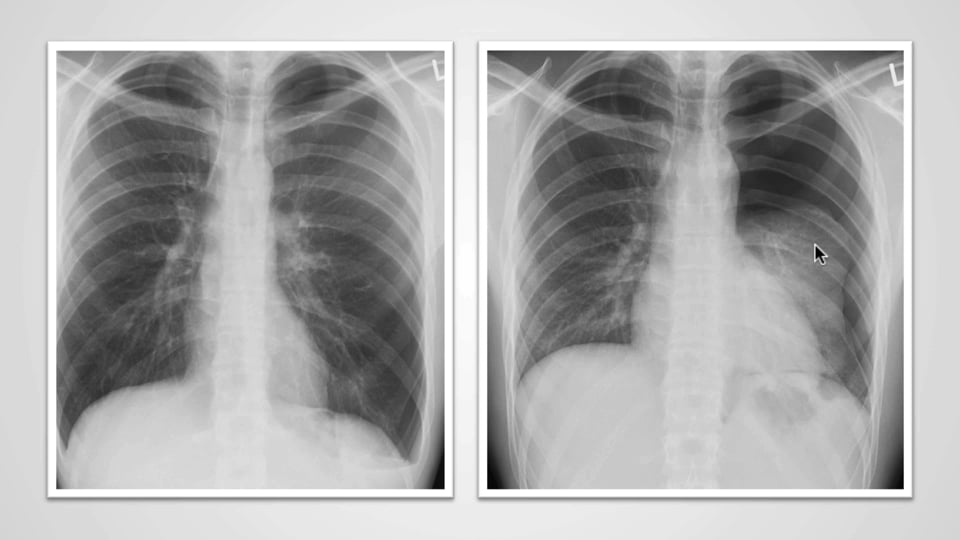 Pleural space – when the pleura is too black