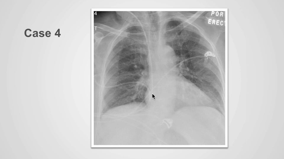 Abnormal central venous catheter positioning