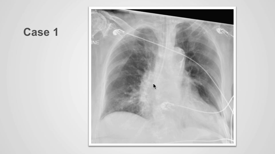 Abnormal ETT positioning