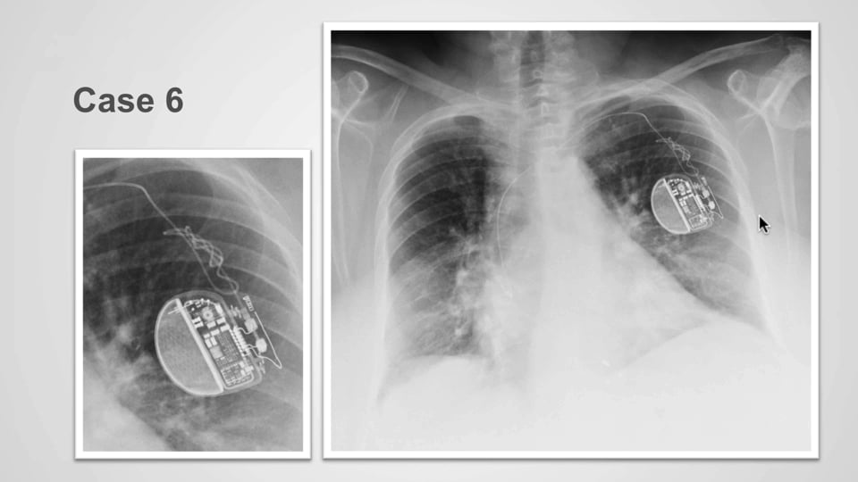 Abnormal cardiac pacer leads positioning