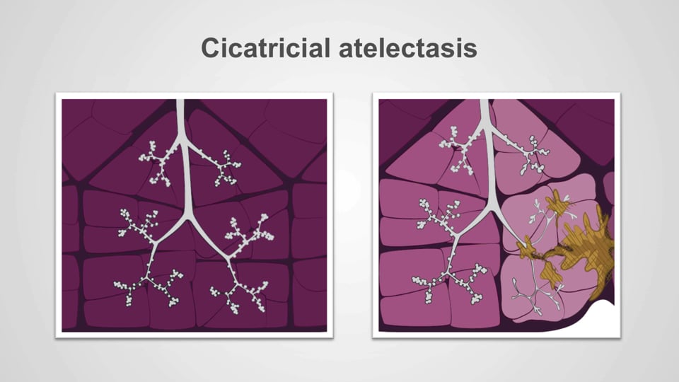 Types of atelectasis
