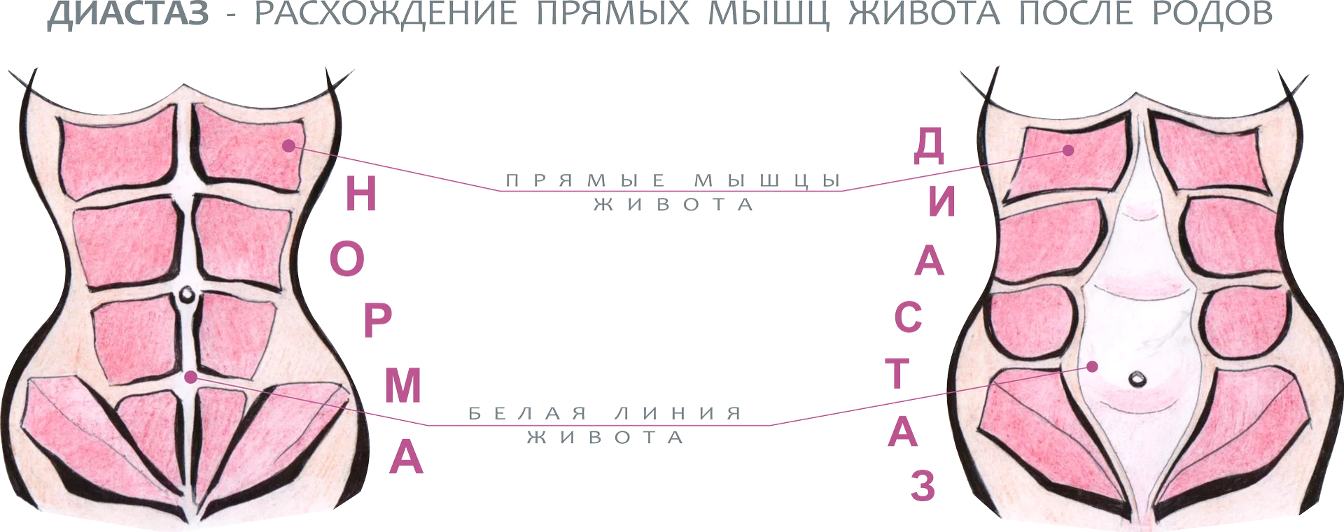 Диастаз прямых мышц живота. Анализ мочи диастаза мочи. Диастаз белой линии живота. Диастаз прямых мышц живота классификация. Что такое диастаз мочи.