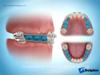 Early Orthodontic Treatment Appliances Videos Pdg Dental