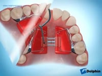 Haas Rapid Palatal Expansion