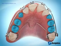 Early Orthodontic Treatment Appliances Videos Pdg Dental