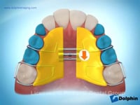 Maxillary Expander Removable