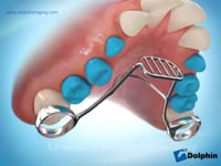  Thumb Habit Appliance