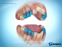 Serial Extraction Therapy