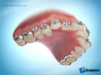 Hawley Retainer