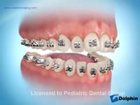 Direct Bonding Procedure