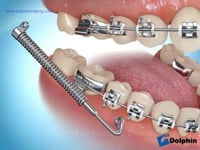 Forsus Appliance (Direct Push Rod)