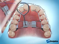  Hyrax Rapid Palatal Expansion Brace