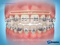 Elastics (Anterior Open Bite)