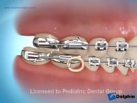 Elastics (Class 2 Overjet)