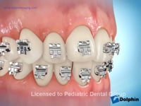 Self Ligating Bracket