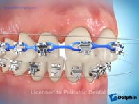 Self Ligating Brackets (Elastomeric Chain Ligation)