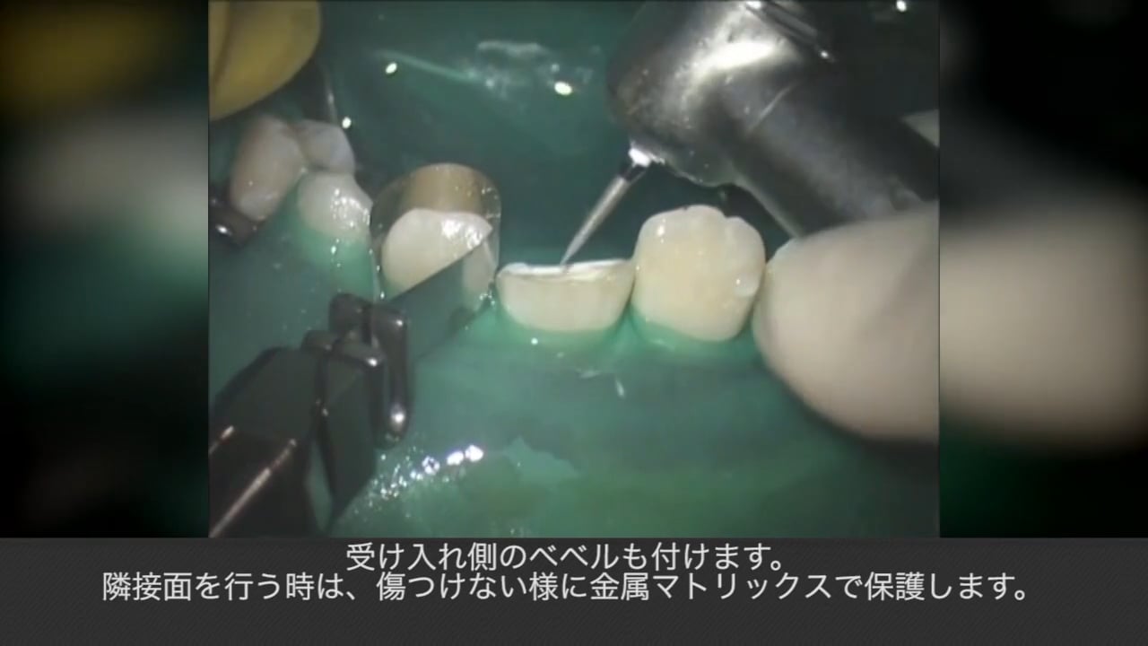 月星光博先生による外傷歯接着治療～ライブオペ～