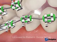 Broken Brackets