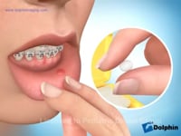 Wax For Patient Comfort