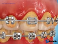 Decalcification Orthodontics