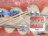 Parts Of Braces