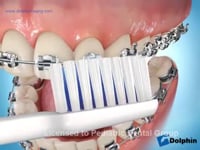 Brushing Techniques With Braces