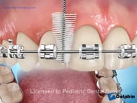 Brushing With Proxabrush
