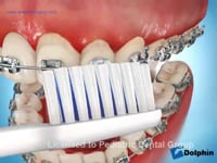  Brushing Techniques - Poor Hygiene