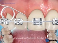 Flossing With Superfloss