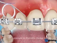 Flossing With Superfloss - Poor Hygiene