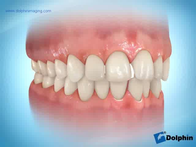 Linguale brackets