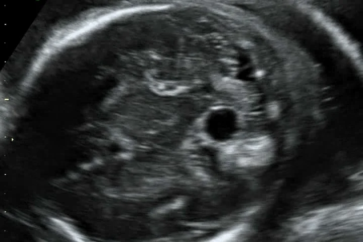 arachnoid cyst ultrasound
