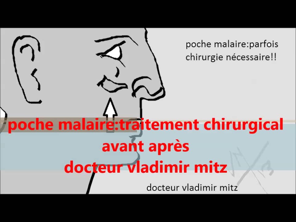 les poches malaires, traitements par vladimir mitz on Vimeo — free download