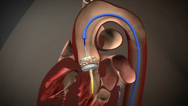 Transfemoral Procedure