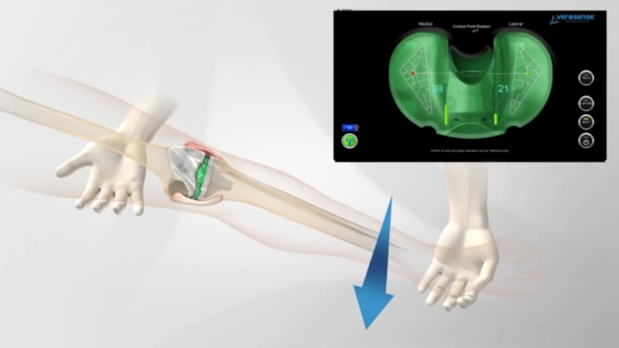 VERASENSE Overview: Benefits of Sensor-Assisted Knee Replacement ...
