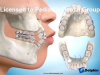 Four-bicuspid Extraction