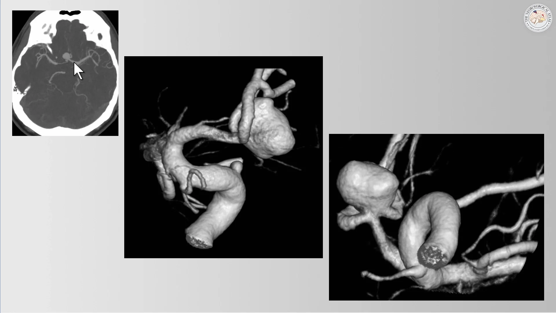 Anterior Communicating Artery Aneurysm | Cohen Collection