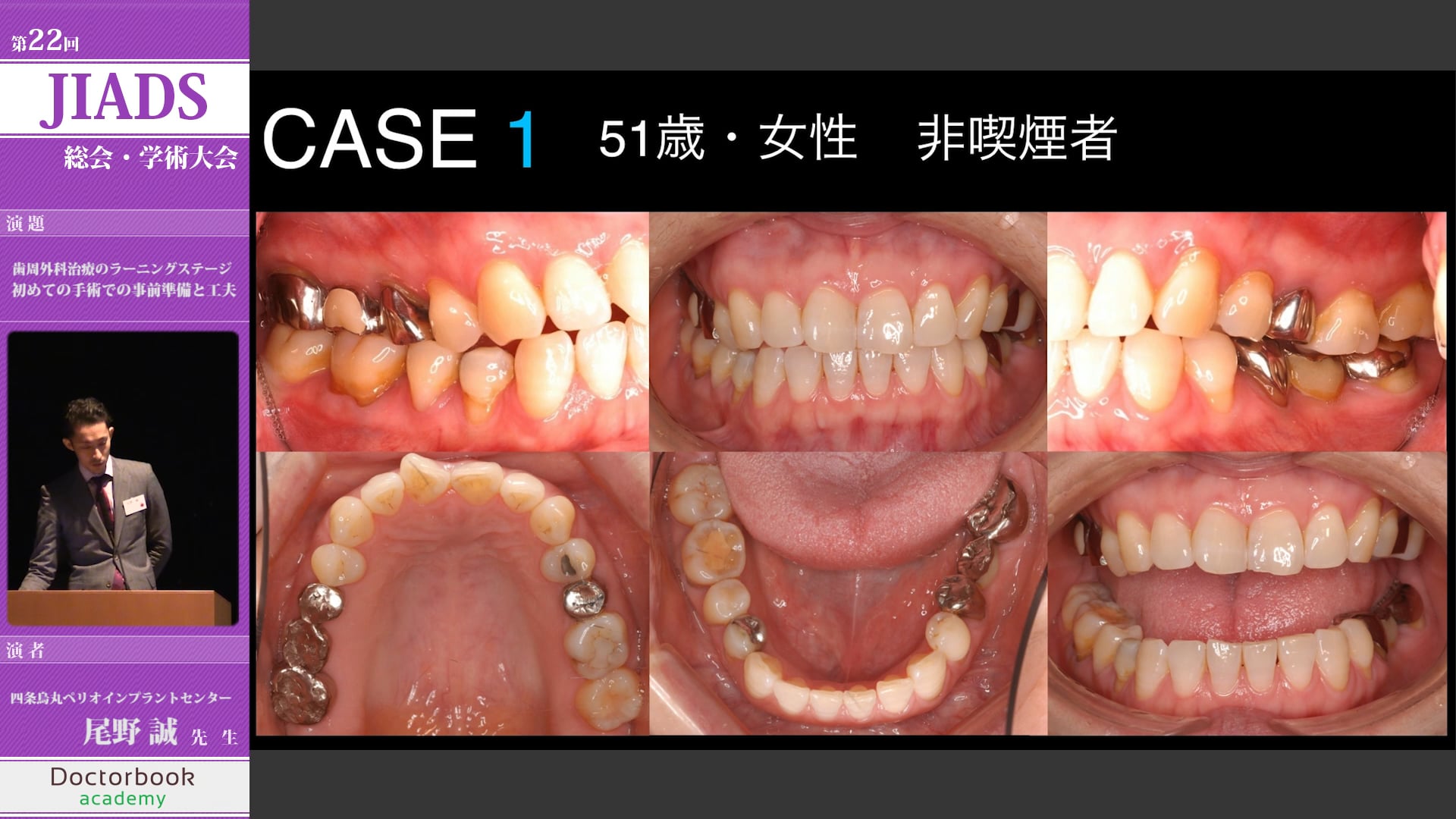 歯周外科治療のラーニングステージ