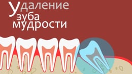Зуб мудрости какой номер. Зуб мудрости где находится. Зуб мудрости какой по счету зуб. Зуб мудрости какой номер. Зуб мудрости какой номер.