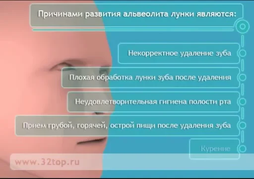 Альвеолит после удаления симптомы фото Альвеолит лунки on Vimeo