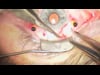 IOL Bisection and Removal