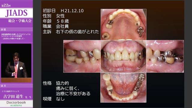 最終補綴物を意識したプロビジョナル・レストレーションの重要性 -JIADSとの関わりを通して-