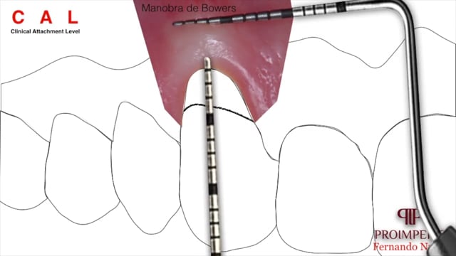 Операция дюкена схема